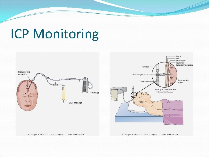 ICP Monitoring 