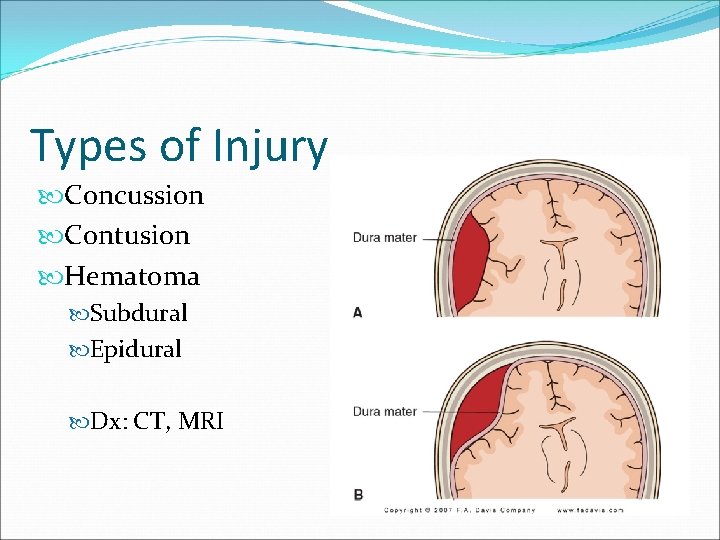 Types of Injury Concussion Contusion Hematoma Subdural Epidural Dx: CT, MRI 