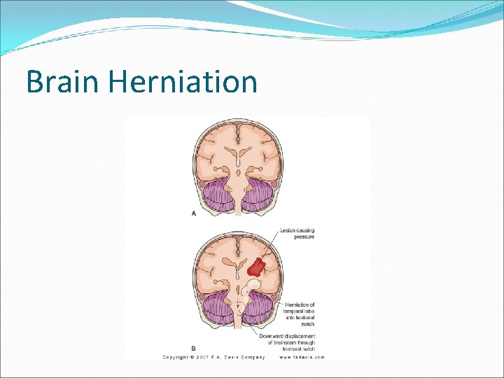 Brain Herniation 