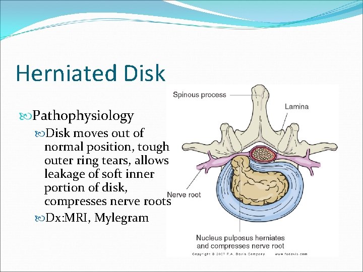 Herniated Disk Pathophysiology Disk moves out of normal position, tough outer ring tears, allows