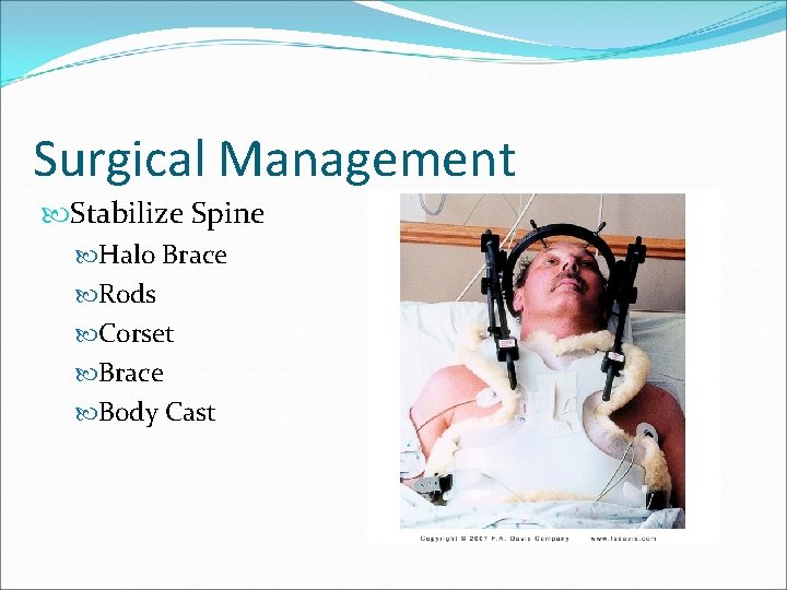 Surgical Management Stabilize Spine Halo Brace Rods Corset Brace Body Cast 