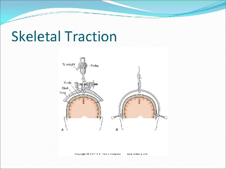 Skeletal Traction 