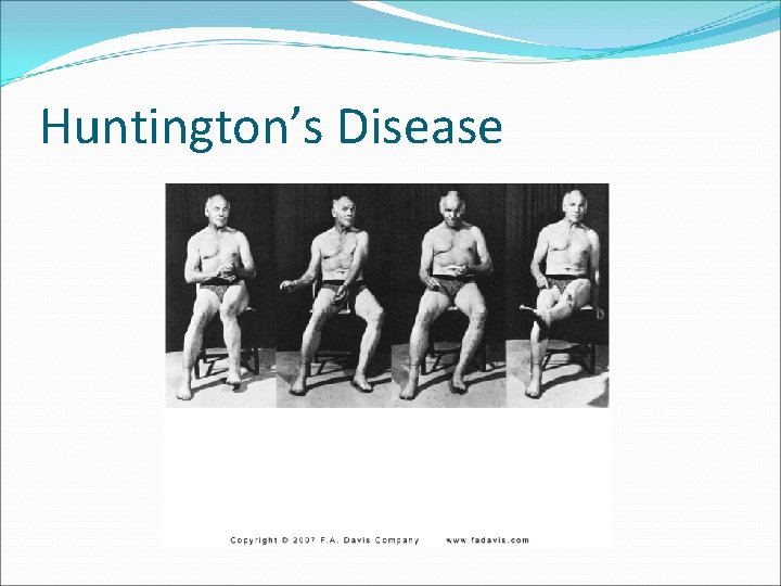 Huntington’s Disease 