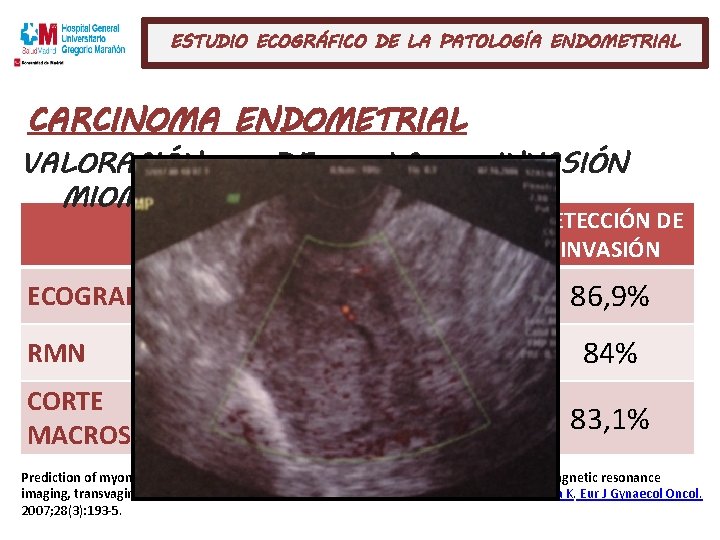 ESTUDIO ECOGRÁFICO DE LA PATOLOGÍA ENDOMETRIAL CARCINOMA ENDOMETRIAL VALORACIÓN DE MIOMETRIAL: ECOGRAFÍA RMN CORTE