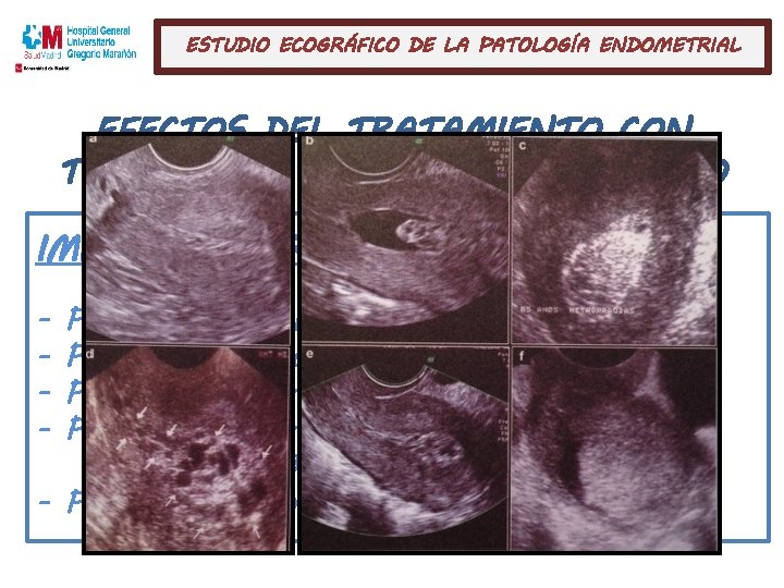 ESTUDIO ECOGRÁFICO DE LA PATOLOGÍA ENDOMETRIAL EFECTOS DEL TRATAMIENTO CON TAMOXIFENO SOBRE EL ENDOMETRIO