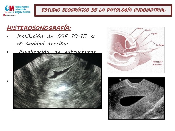 ESTUDIO ECOGRÁFICO DE LA PATOLOGÍA ENDOMETRIAL HISTEROSONOGRAFÍA: • Instilación de SSF 10 -15 cc