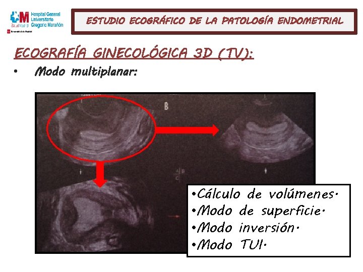 ESTUDIO ECOGRÁFICO DE LA PATOLOGÍA ENDOMETRIAL ECOGRAFÍA GINECOLÓGICA 3 D (TV): • Modo multiplanar: