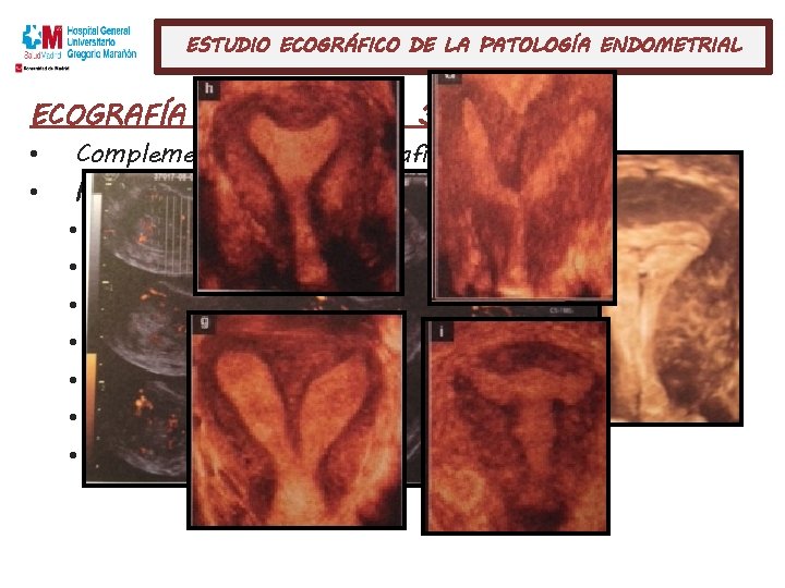 ESTUDIO ECOGRÁFICO DE LA PATOLOGÍA ENDOMETRIAL ECOGRAFÍA GINECOLÓGICA 3 D (TV): • • Complementaria
