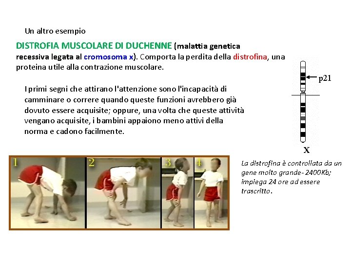 Un altro esempio DISTROFIA MUSCOLARE DI DUCHENNE (malattia genetica recessiva legata al cromosoma x).