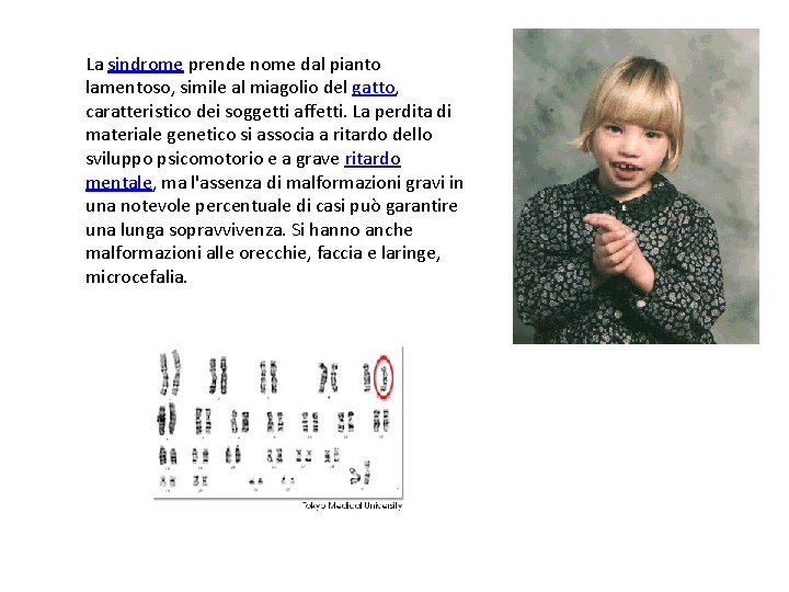 La sindrome prende nome dal pianto lamentoso, simile al miagolio del gatto, caratteristico dei