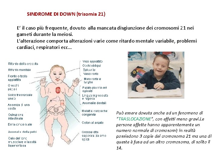 SINDROME DI DOWN (trisomia 21) E’ il caso più frequente, dovuto alla mancata disgiunzione