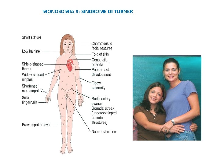 MONOSOMIA X: SINDROME DI TURNER 