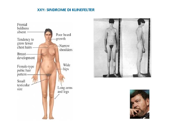 XXY: SINDROME DI KLINEFELTER 