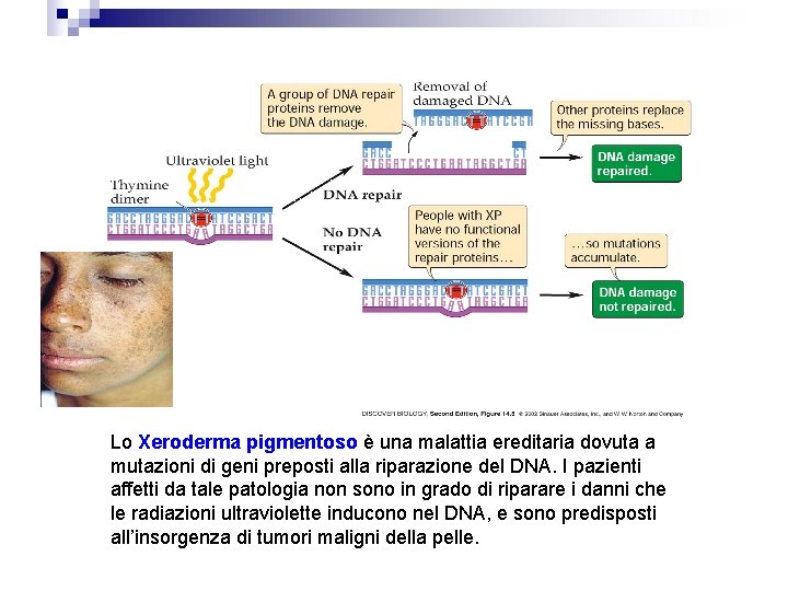 Lo Xeroderma pigmentoso è una malattia ereditaria dovuta a mutazioni di geni preposti alla