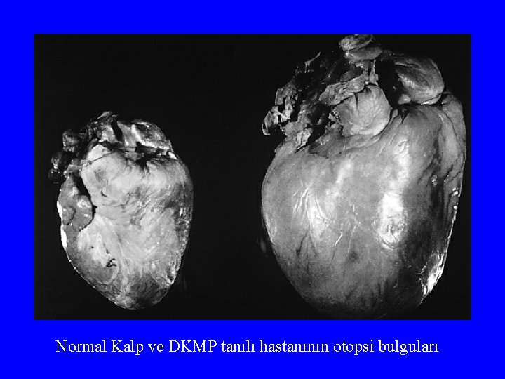Normal Kalp ve DKMP tanılı hastanının otopsi bulguları 