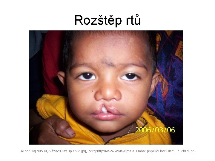 Rozštěp rtů Autor: Raj d 0509, Název: Cleft lip child. jpg, Zdroj: http: //www.