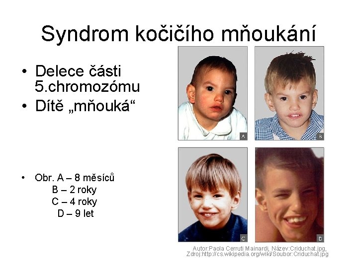 Syndrom kočičího mňoukání • Delece části 5. chromozómu • Dítě „mňouká“ • Obr. A