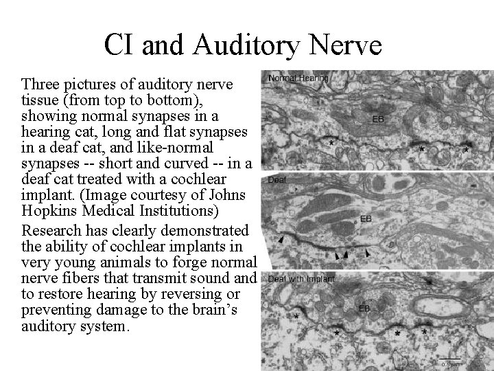 CI and Auditory Nerve Three pictures of auditory nerve tissue (from top to bottom),