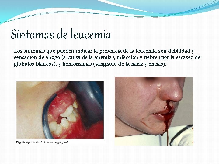 Síntomas de leucemia Los síntomas que pueden indicar la presencia de la leucemia son