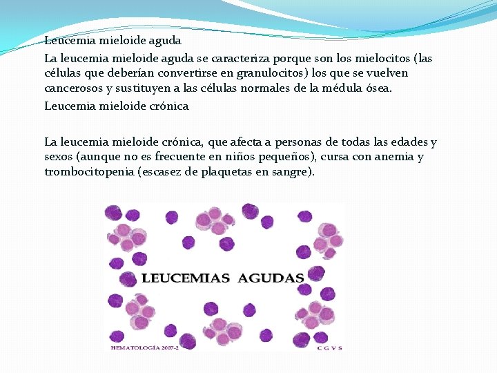 Leucemia mieloide aguda La leucemia mieloide aguda se caracteriza porque son los mielocitos (las