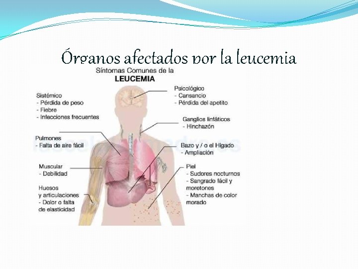 Órganos afectados por la leucemia 