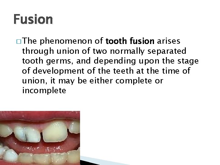 Fusion � The phenomenon of tooth fusion arises through union of two normally separated