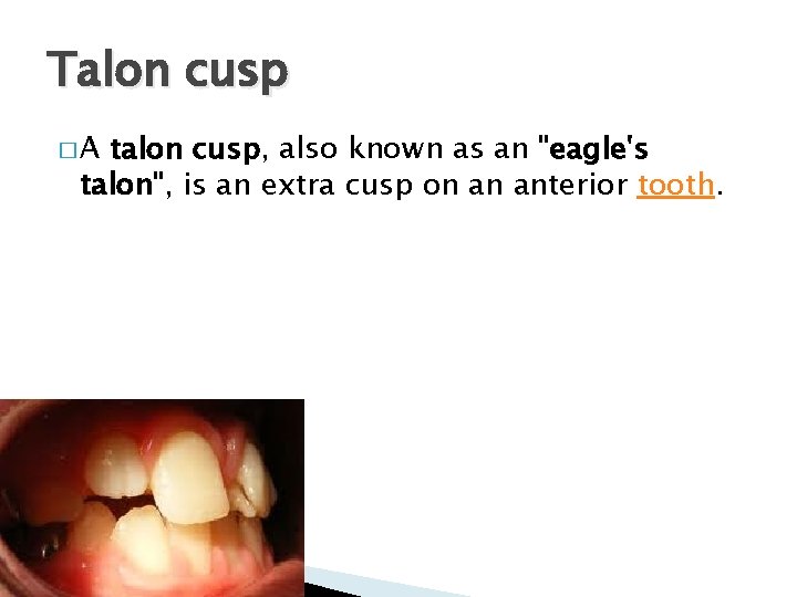 Talon cusp � A talon cusp, also known as an "eagle's talon", is an