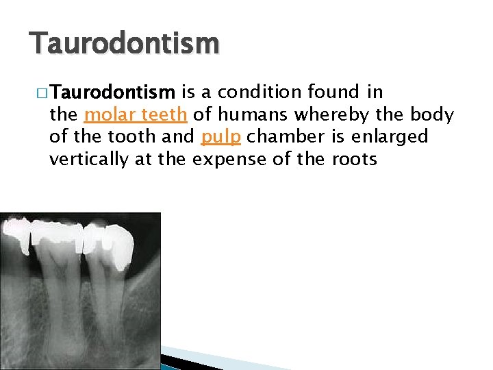 Taurodontism � Taurodontism is a condition found in the molar teeth of humans whereby