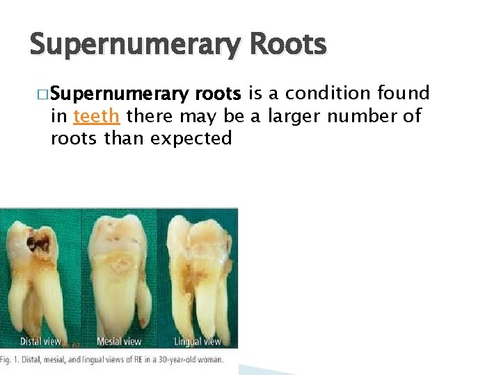 Supernumerary Roots � Supernumerary roots is a condition found in teeth there may be