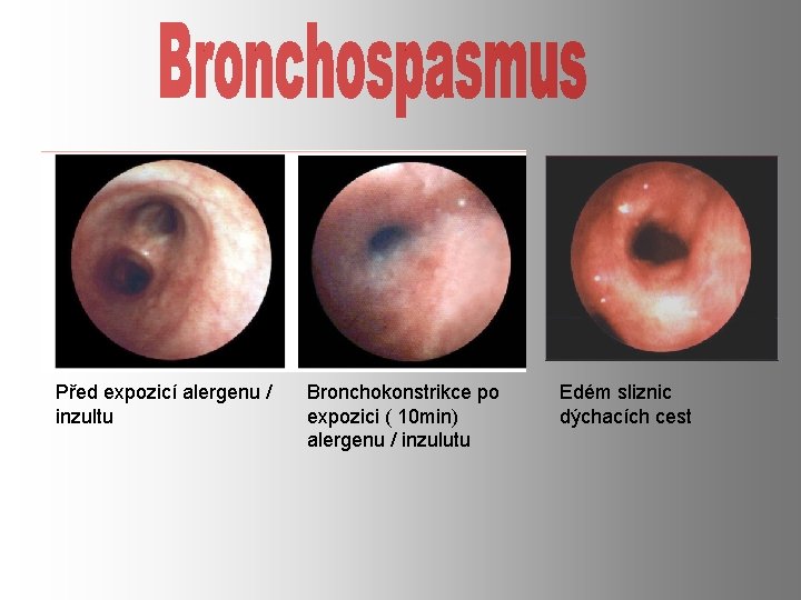 Před expozicí alergenu / inzultu Bronchokonstrikce po expozici ( 10 min) alergenu / inzulutu Před expozicí alergenu / inzultu Bronchokonstrikce po expozici ( 10 min) alergenu / inzulutu