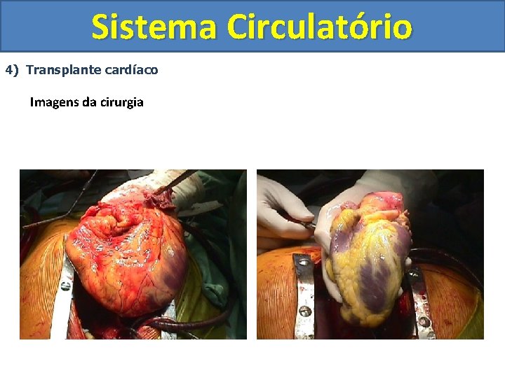 Sistema Circulatório 4) Transplante cardíaco Imagens da cirurgia 