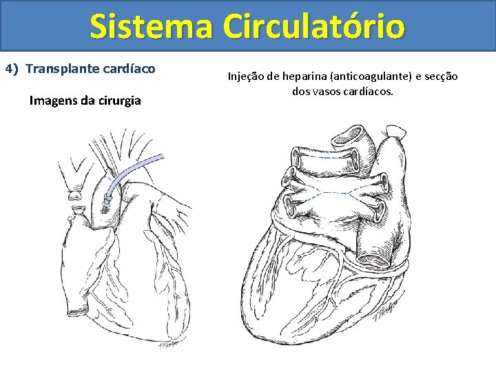 Sistema Circulatório 4) Transplante cardíaco Imagens da cirurgia Injeção de heparina (anticoagulante) e secção