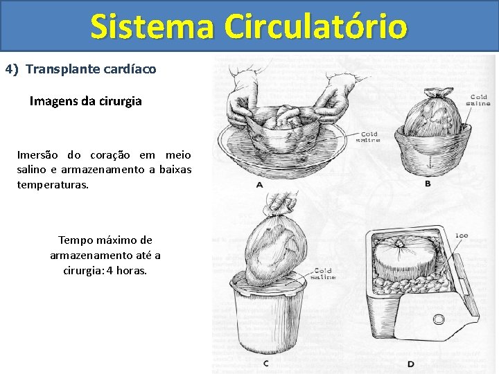 Sistema Circulatório 4) Transplante cardíaco Imagens da cirurgia Imersão do coração em meio salino
