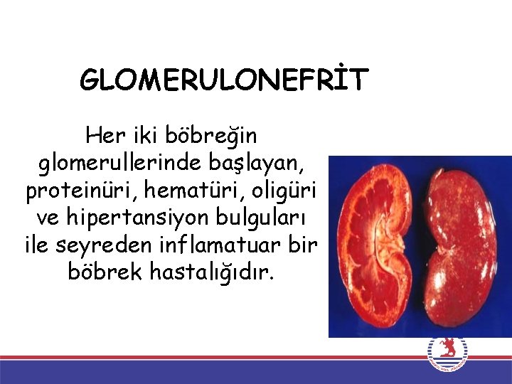 GLOMERULONEFRİT Her iki böbreğin glomerullerinde başlayan, proteinüri, hematüri, oligüri ve hipertansiyon bulguları ile seyreden GLOMERULONEFRİT Her iki böbreğin glomerullerinde başlayan, proteinüri, hematüri, oligüri ve hipertansiyon bulguları ile seyreden
