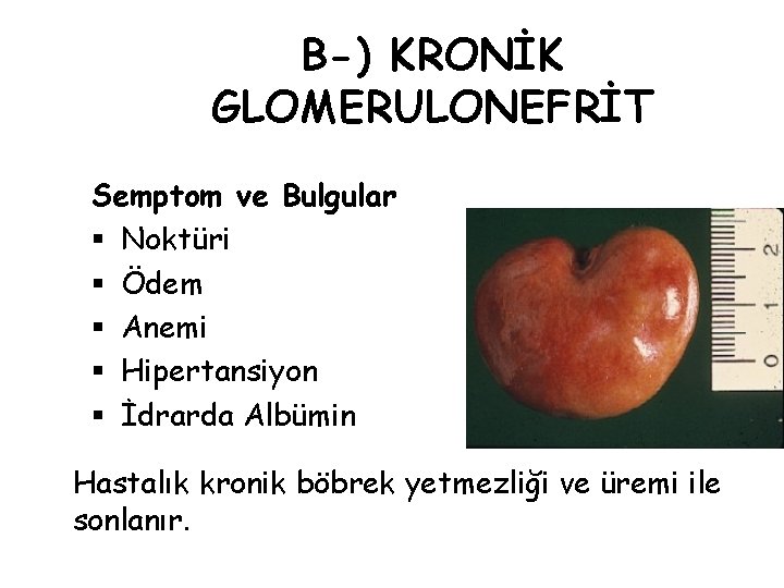 B-) KRONİK GLOMERULONEFRİT Semptom ve Bulgular § Noktüri § Ödem § Anemi § Hipertansiyon B-) KRONİK GLOMERULONEFRİT Semptom ve Bulgular § Noktüri § Ödem § Anemi § Hipertansiyon