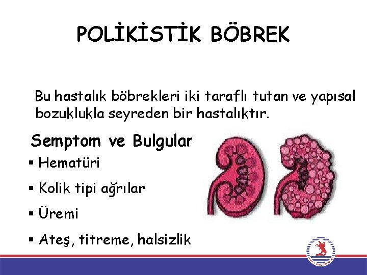 POLİKİSTİK BÖBREK Bu hastalık böbrekleri iki taraflı tutan ve yapısal bozuklukla seyreden bir hastalıktır. POLİKİSTİK BÖBREK Bu hastalık böbrekleri iki taraflı tutan ve yapısal bozuklukla seyreden bir hastalıktır.