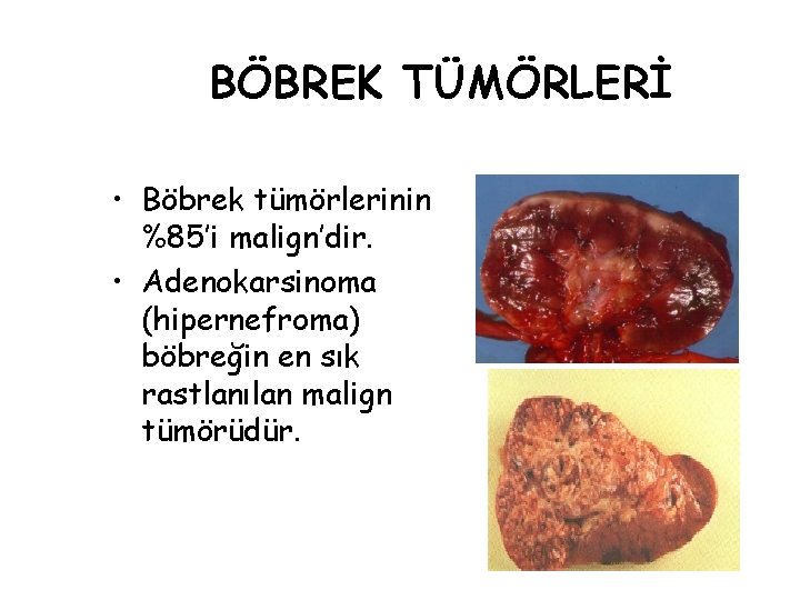 BÖBREK TÜMÖRLERİ • Böbrek tümörlerinin %85’i malign’dir. • Adenokarsinoma (hipernefroma) böbreğin en sık rastlanılan BÖBREK TÜMÖRLERİ • Böbrek tümörlerinin %85’i malign’dir. • Adenokarsinoma (hipernefroma) böbreğin en sık rastlanılan