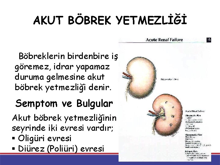 AKUT BÖBREK YETMEZLİĞİ Böbreklerin birdenbire iş göremez, idrar yapamaz duruma gelmesine akut böbrek yetmezliği AKUT BÖBREK YETMEZLİĞİ Böbreklerin birdenbire iş göremez, idrar yapamaz duruma gelmesine akut böbrek yetmezliği