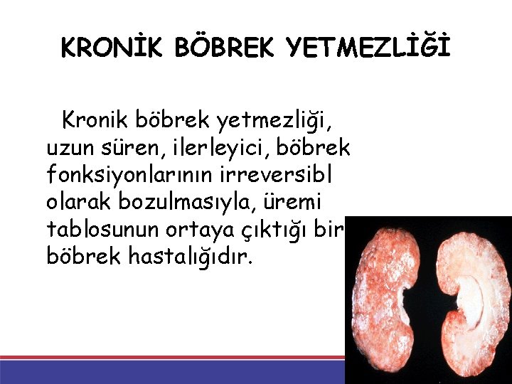 KRONİK BÖBREK YETMEZLİĞİ Kronik böbrek yetmezliği, uzun süren, ilerleyici, böbrek fonksiyonlarının irreversibl olarak bozulmasıyla, KRONİK BÖBREK YETMEZLİĞİ Kronik böbrek yetmezliği, uzun süren, ilerleyici, böbrek fonksiyonlarının irreversibl olarak bozulmasıyla,