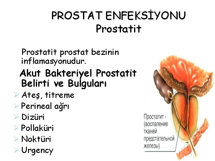 PROSTAT ENFEKSİYONU Prostatit prostat bezinin inflamasyonudur. Akut Bakteriyel Prostatit Belirti ve Bulguları Ø Ateş, PROSTAT ENFEKSİYONU Prostatit prostat bezinin inflamasyonudur. Akut Bakteriyel Prostatit Belirti ve Bulguları Ø Ateş,