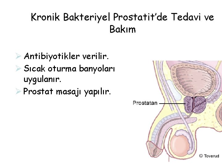 Kronik Bakteriyel Prostatit’de Tedavi ve Bakım Ø Antibiyotikler verilir. Ø Sıcak oturma banyoları uygulanır. Kronik Bakteriyel Prostatit’de Tedavi ve Bakım Ø Antibiyotikler verilir. Ø Sıcak oturma banyoları uygulanır.