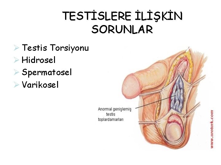 TESTİSLERE İLİŞKİN SORUNLAR Ø Testis Torsiyonu Ø Hidrosel Ø Spermatosel Ø Varikosel TESTİSLERE İLİŞKİN SORUNLAR Ø Testis Torsiyonu Ø Hidrosel Ø Spermatosel Ø Varikosel