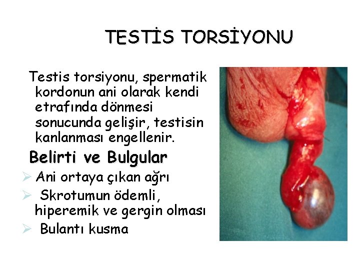 TESTİS TORSİYONU Testis torsiyonu, spermatik kordonun ani olarak kendi etrafında dönmesi sonucunda gelişir, testisin TESTİS TORSİYONU Testis torsiyonu, spermatik kordonun ani olarak kendi etrafında dönmesi sonucunda gelişir, testisin