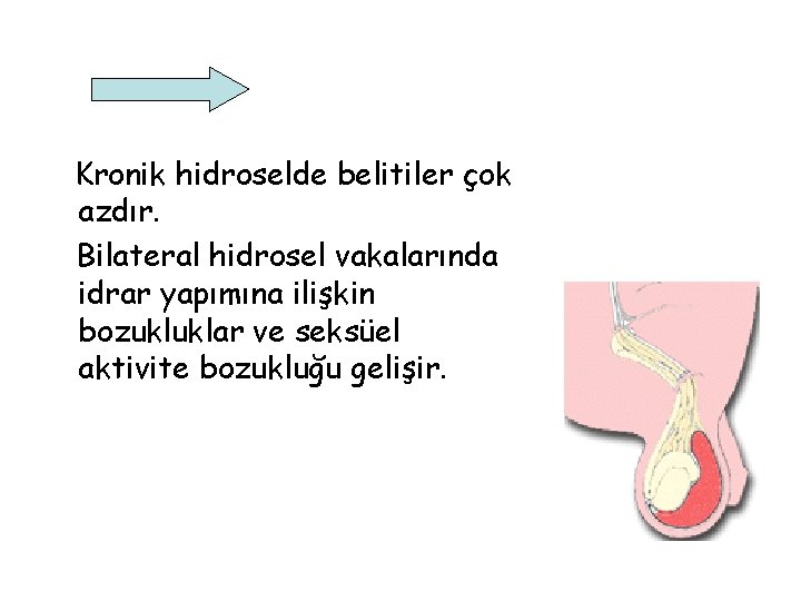 Kronik hidroselde belitiler çok azdır. Bilateral hidrosel vakalarında idrar yapımına ilişkin bozukluklar ve seksüel Kronik hidroselde belitiler çok azdır. Bilateral hidrosel vakalarında idrar yapımına ilişkin bozukluklar ve seksüel