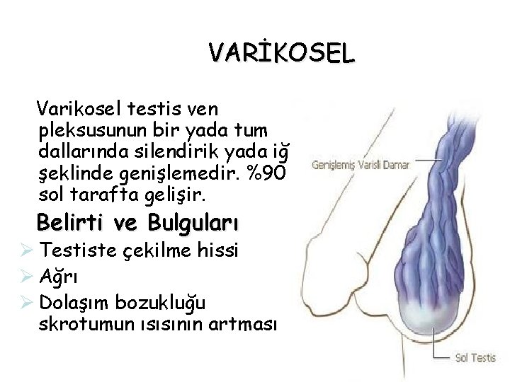 VARİKOSEL Varikosel testis ven pleksusunun bir yada tum dallarında silendirik yada iğ şeklinde genişlemedir. VARİKOSEL Varikosel testis ven pleksusunun bir yada tum dallarında silendirik yada iğ şeklinde genişlemedir.