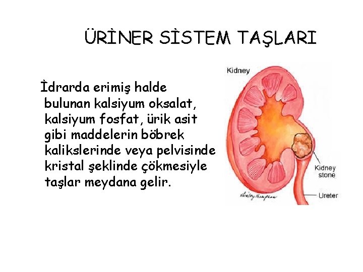 ÜRİNER SİSTEM TAŞLARI İdrarda erimiş halde bulunan kalsiyum oksalat, kalsiyum fosfat, ürik asit gibi ÜRİNER SİSTEM TAŞLARI İdrarda erimiş halde bulunan kalsiyum oksalat, kalsiyum fosfat, ürik asit gibi