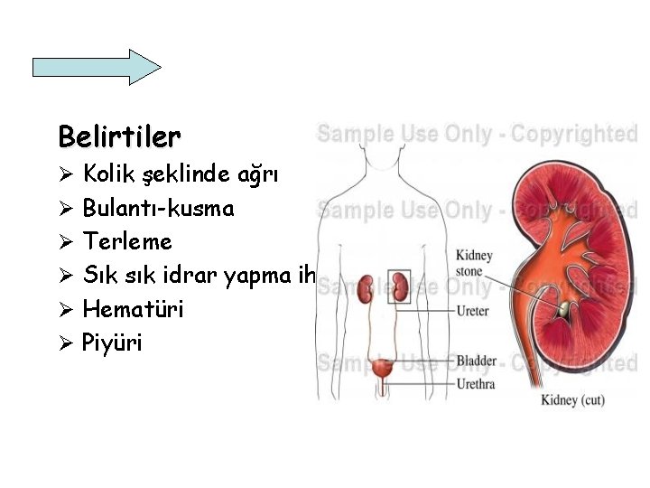 Belirtiler Ø Kolik şeklinde ağrı Ø Bulantı-kusma Ø Terleme Ø Sık sık idrar yapma Belirtiler Ø Kolik şeklinde ağrı Ø Bulantı-kusma Ø Terleme Ø Sık sık idrar yapma