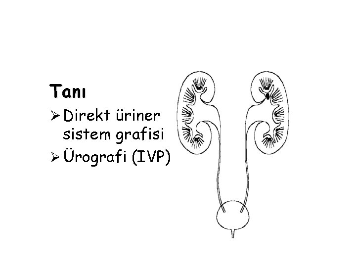 Tanı Ø Direkt üriner sistem grafisi Ø Ürografi (IVP) Tanı Ø Direkt üriner sistem grafisi Ø Ürografi (IVP)