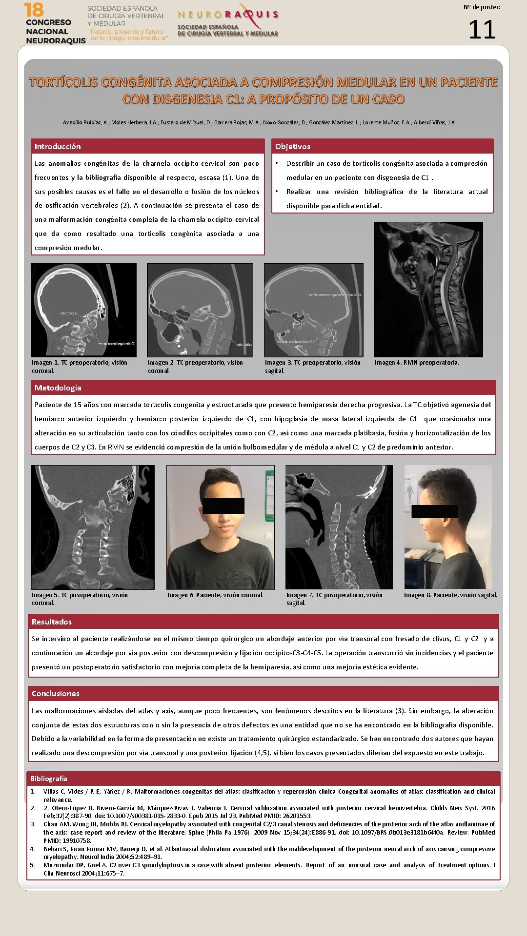 Nº de poster: 11 TORTÍCOLIS CONGÉNITA ASOCIADA A COMPRESIÓN MEDULAR EN UN PACIENTE CON Nº de poster: 11 TORTÍCOLIS CONGÉNITA ASOCIADA A COMPRESIÓN MEDULAR EN UN PACIENTE CON