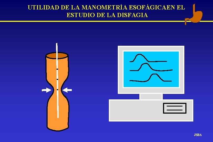 UTILIDAD DE LA MANOMETRÍA ESOFÁGICAEN EL ESTUDIO DE LA DISFAGIA JSBA UTILIDAD DE LA MANOMETRÍA ESOFÁGICAEN EL ESTUDIO DE LA DISFAGIA JSBA